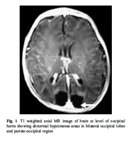 Brain MRI of hypoglycemic breastfed baby