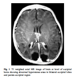 Here's an alt tag for the image: `Axial brain MRI showing abnormal areas`