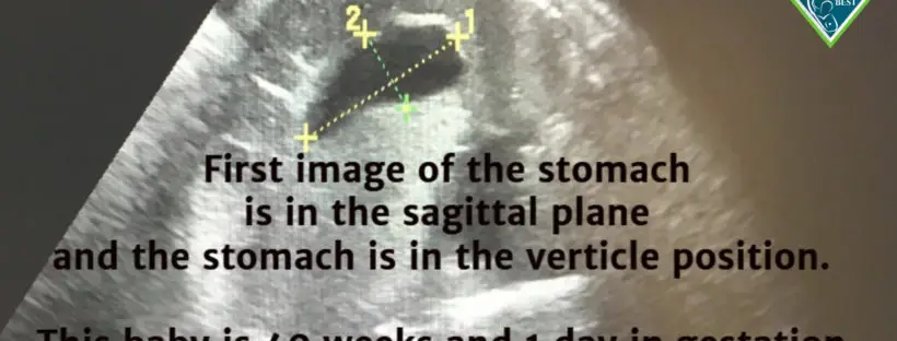 Fetal ultrasound: stomach in sagittal view.