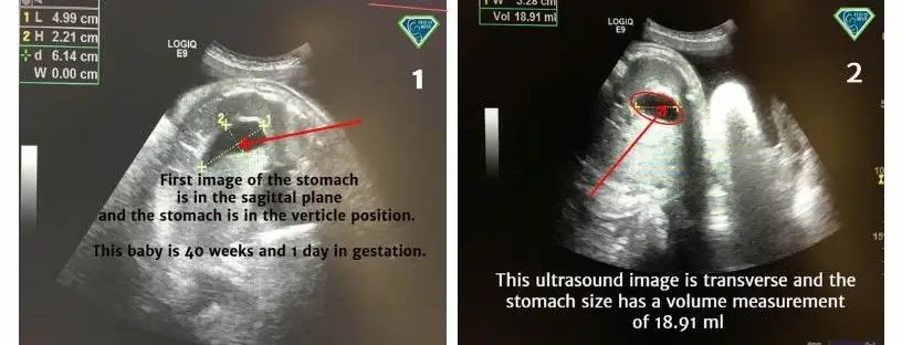 Fetal stomach ultrasound at 40 weeks.