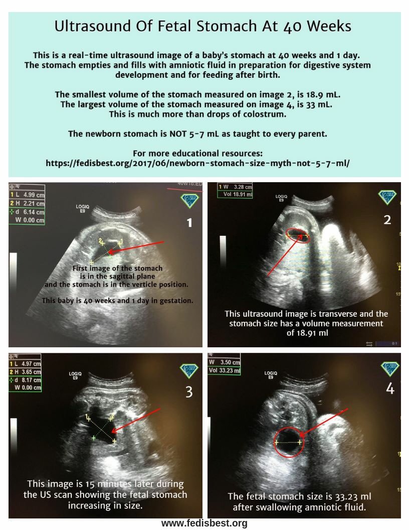 The Newborn Stomach Size Myth: It is NOT 5-7 mL - Fed Is Best