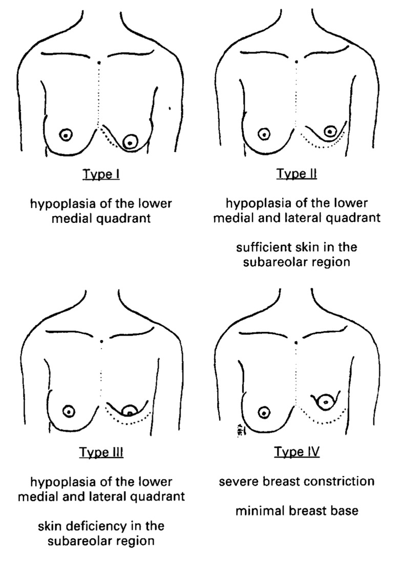 Hypoplasia