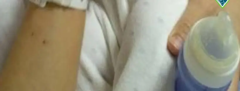 Patient's arm with feeding tube.