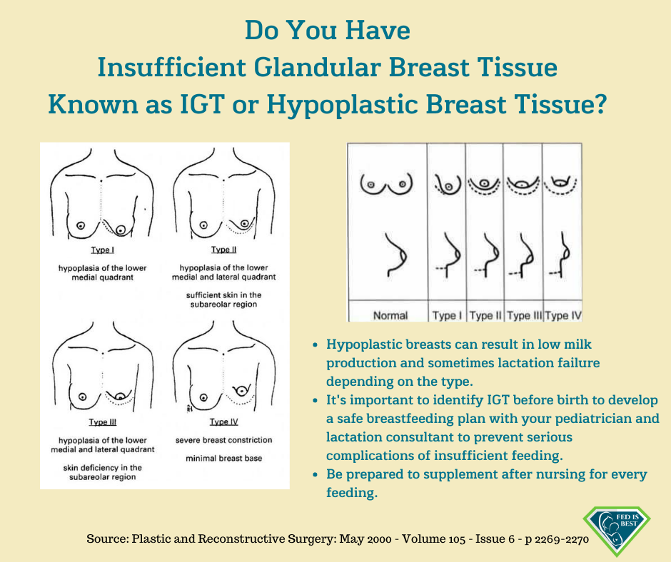 What is Tubular Breast, How Is It Diagnosed?