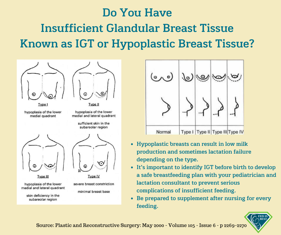 Hypoplastic breasts?